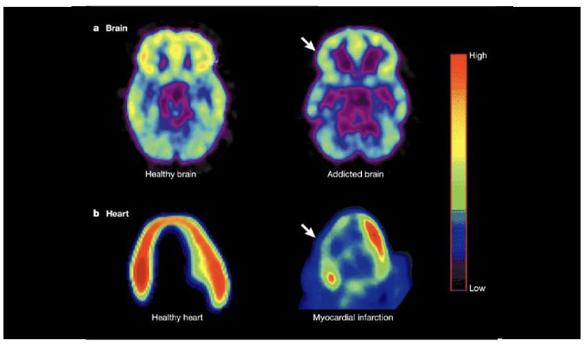 Reward Deficiency Syndrome